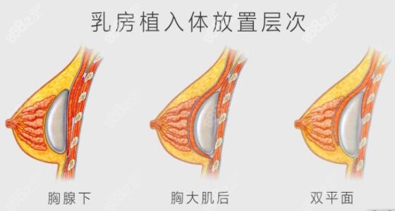 王爱武隆胸价格