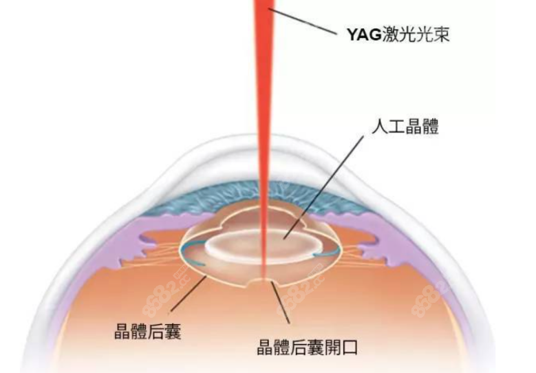 YAG激光后囊膜切开术8682.cc