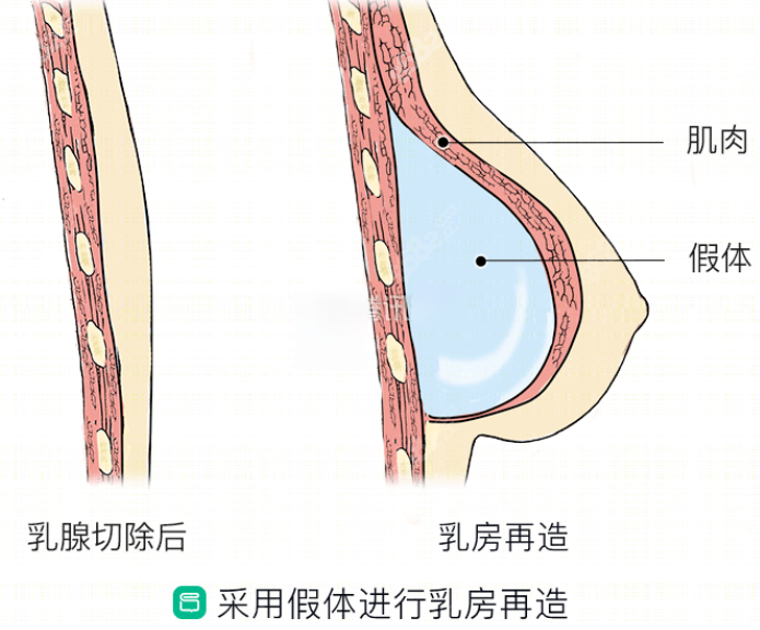 乳房再造