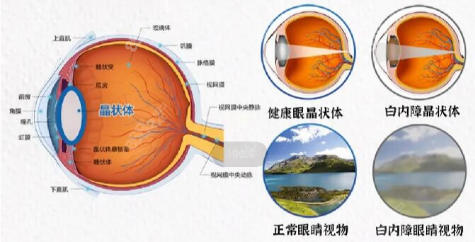 白内障单焦点人工晶体优缺点