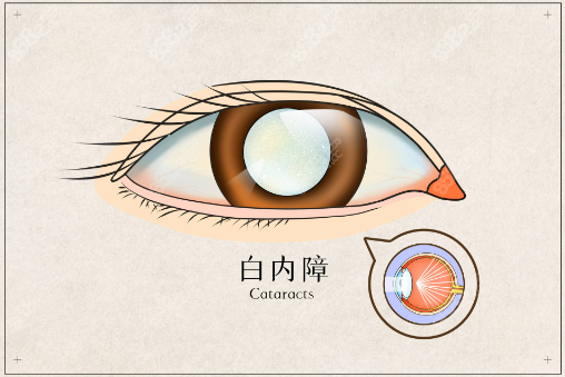 郑州白内障手术哪家做的好www.8682.cc