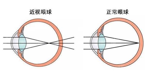 大连近视眼手术哪个医院好