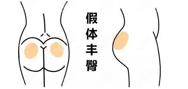 泰国暹罗娜整形官网简介看泰国暹罗娜整形假体丰臀
