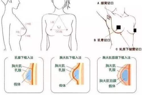 杭州维多利亚隆胸怎么样