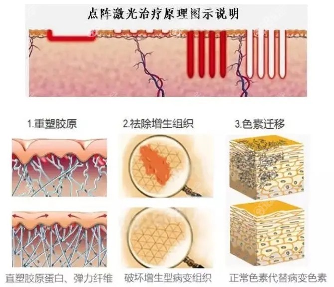 太原时光整形做疤痕修复采用点阵激光的原理