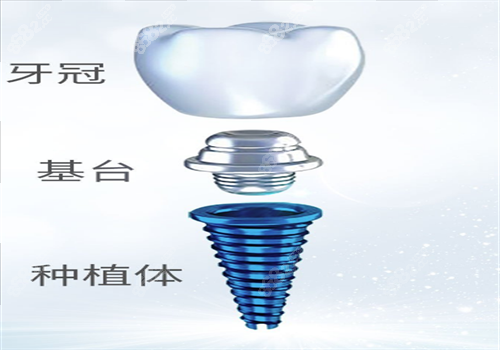 北京种植牙图