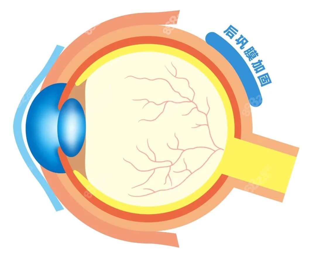 后巩膜加固术手术原理