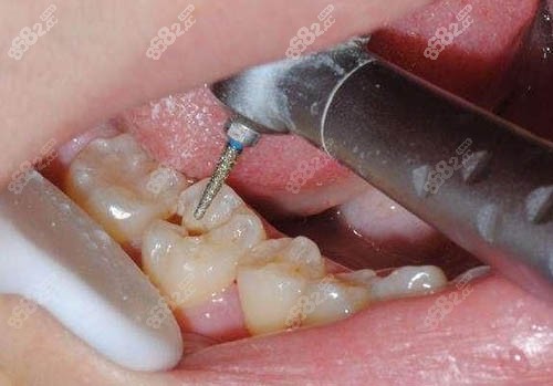 补牙治疗图