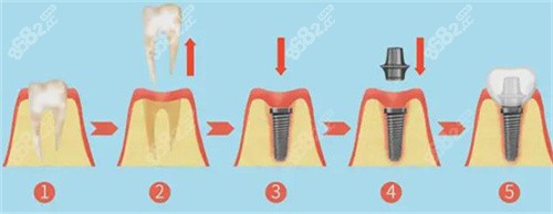 种植牙过程图