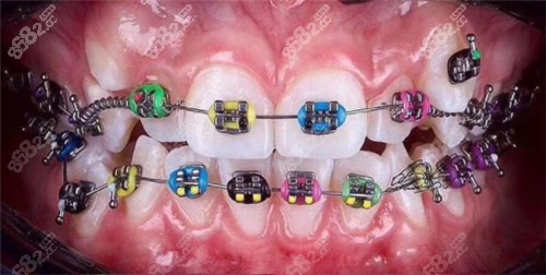 金属矫正细节图