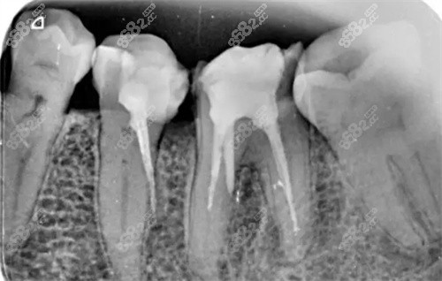 根管治疗牙齿ct照片