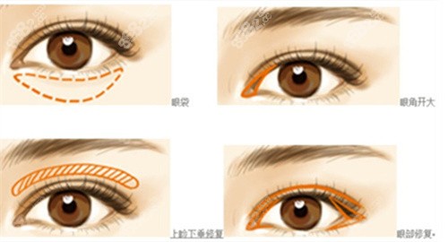 成都韩妃整形医院双眼皮价格多少钱？