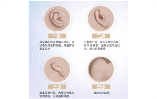 小耳畸形的程度等级图片