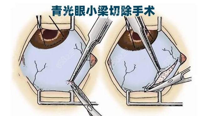 青光眼小梁切除手术www.8682.cc