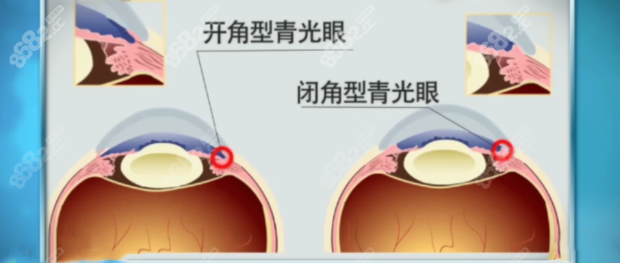 开角型青光眼和闭角型青光眼