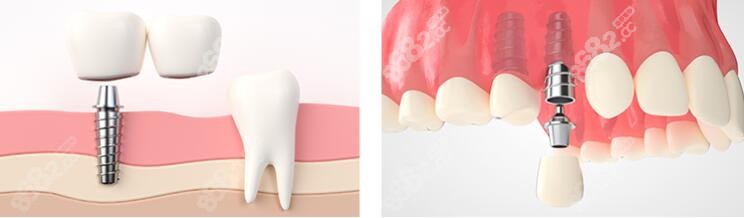 韩系种植牙和欧美种植牙有什么区别
