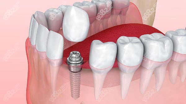 <!--<i data=20240705-sp></i>-->口腔医院种植牙怎么样