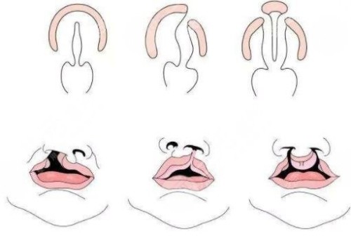 广州哪个医生做唇腭裂手术高？