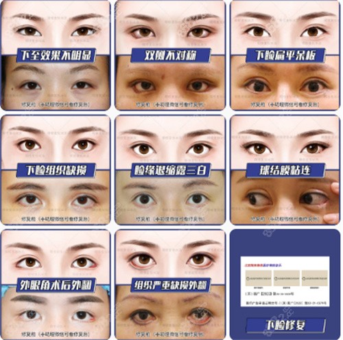 张冰洁修复双眼皮怎么样？