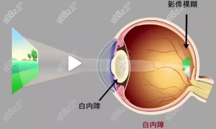 白内障