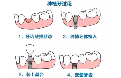 种植牙过程展示图
