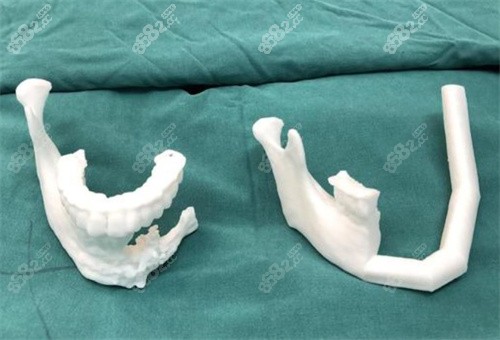3D打印补骨图