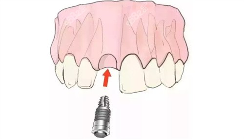 种植体安装过程演示图