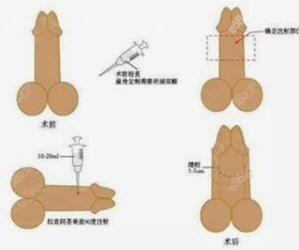 玻尿酸增粗术