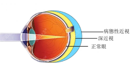 不同情况眼轴长度与眼部形态对比