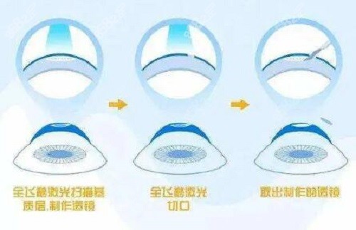 惠州希玛眼科医院收费怎么样
