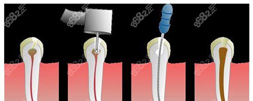 根管治疗过程示意图