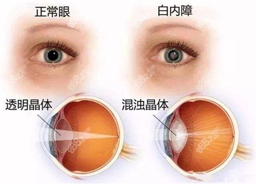 老人申请免费白内障手术和自费白内障手术有啥区别？