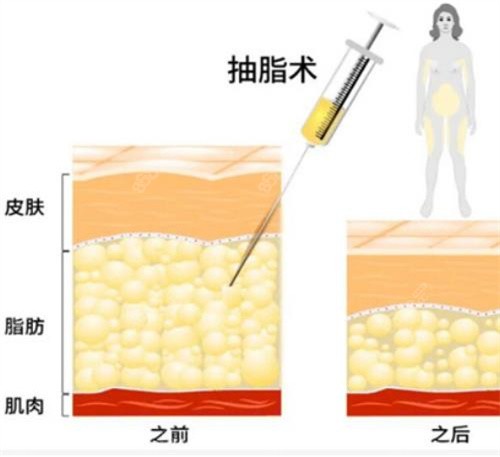 大连美天整形医院吸脂塑形价格表