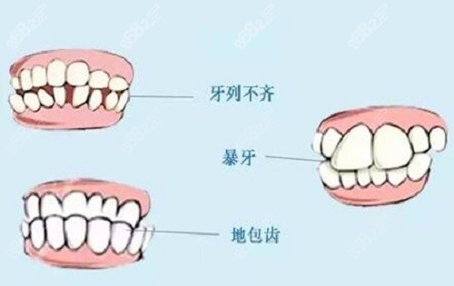 牙齿畸形.jpg