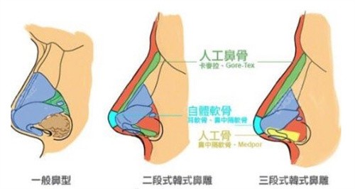 新疆整形医院刘丽娜隆鼻