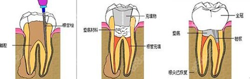 根管治疗步骤示意图