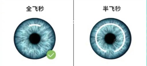 全激光近视手术多久能恢复