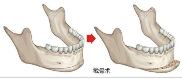 磨骨手术图示