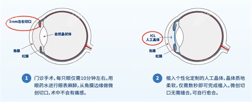 全激光近视手术不会反弹