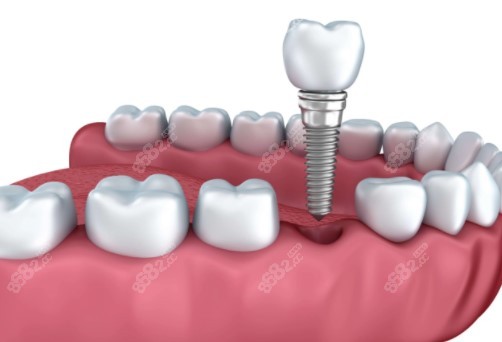 临沂镶种植牙哪里比较好