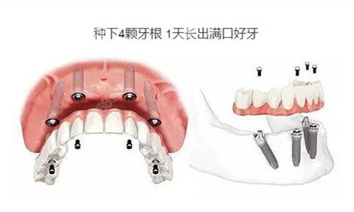 全口即刻种植牙示意图