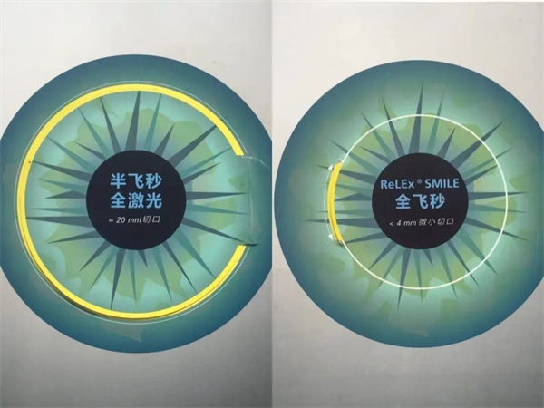 深圳全激光，半飞秒与全飞秒近视手术方式有什么不同呢