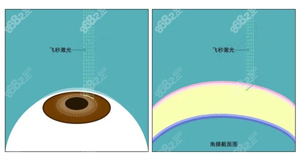 近视眼手术