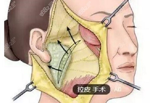 上海倪锋博士拉皮怎么样