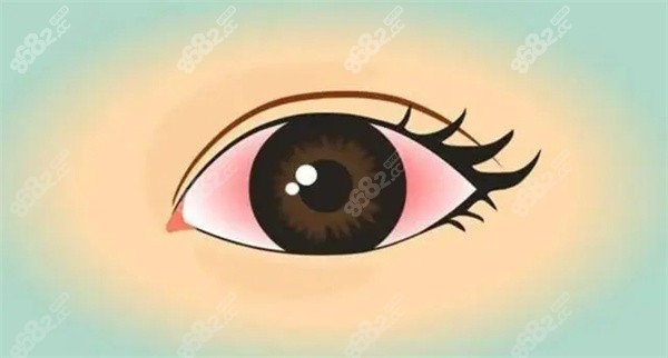 有角膜炎能做近视手术吗？得了角膜炎做近视手术风险大吗
