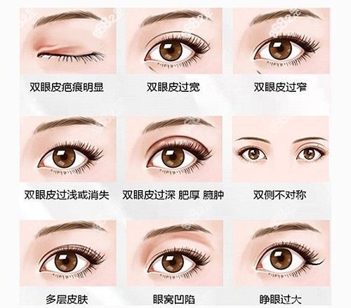 <!--<i data=20240705-sp></i>-->修复双眼皮价格贵吗？