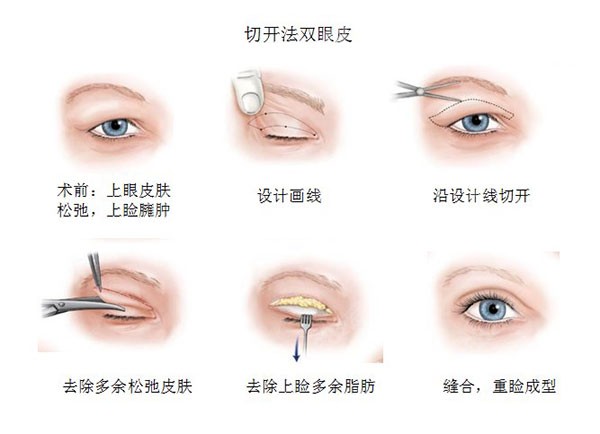 双眼皮埋线修复过程图图片