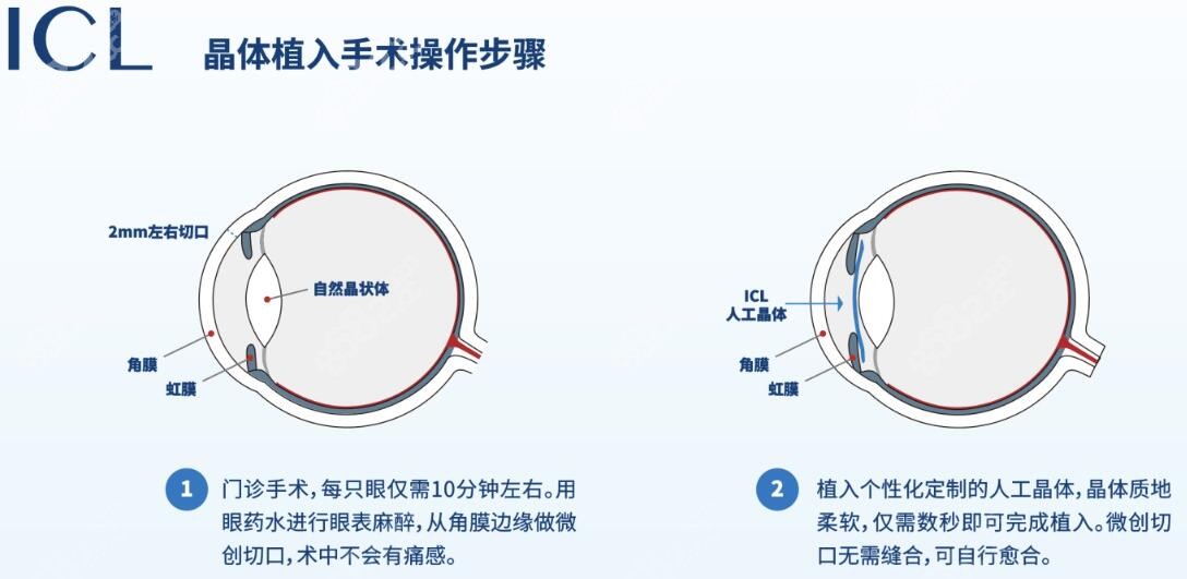 重庆近视眼手术价格表