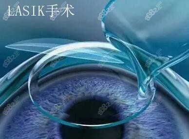 重庆近视眼手术哪家医院好
