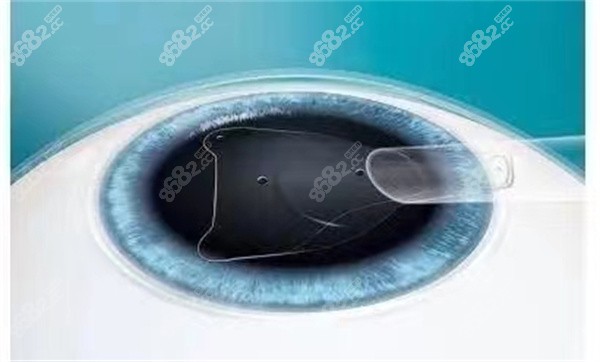 做晶体植入近视手术适合哪些类型人群 做晶体植入近视手术适合哪些类型人群